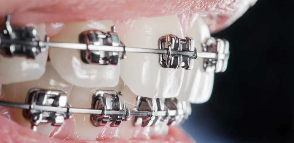 Brackets Metálicos en CeDeMed