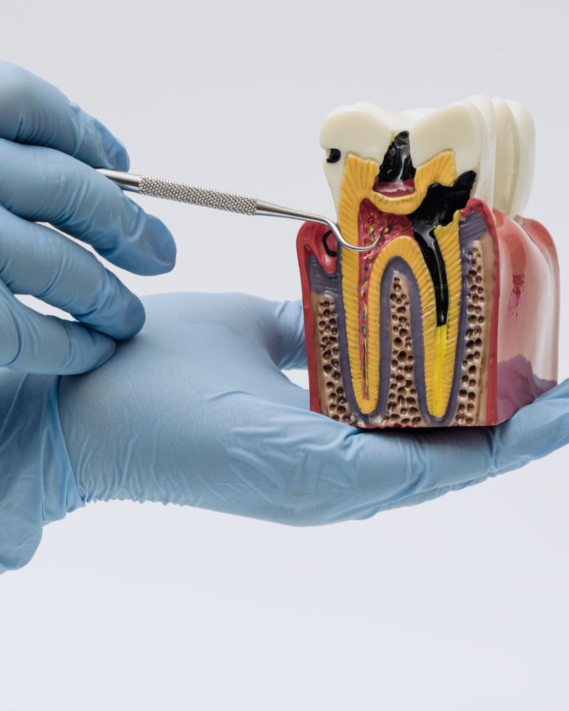 Modelo Dental Diagnóstico Preciso