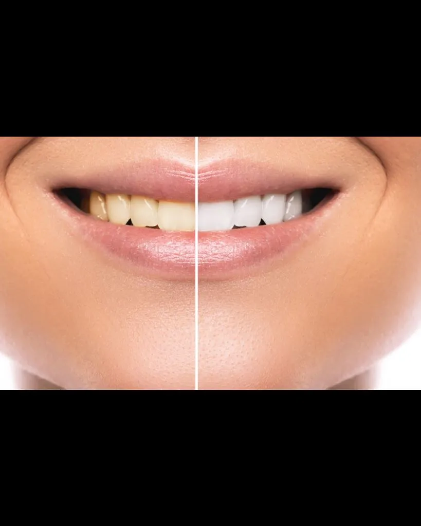 Blanqueamiento Dental Antes y Después