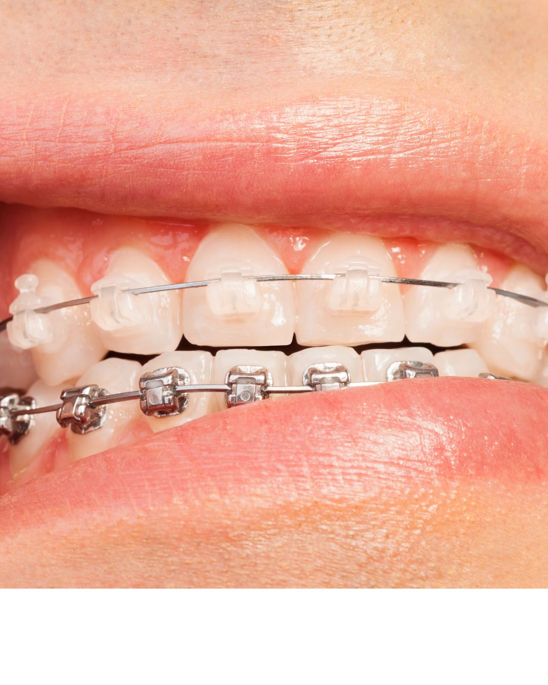 Brackets de Zafiro en CeDeMed