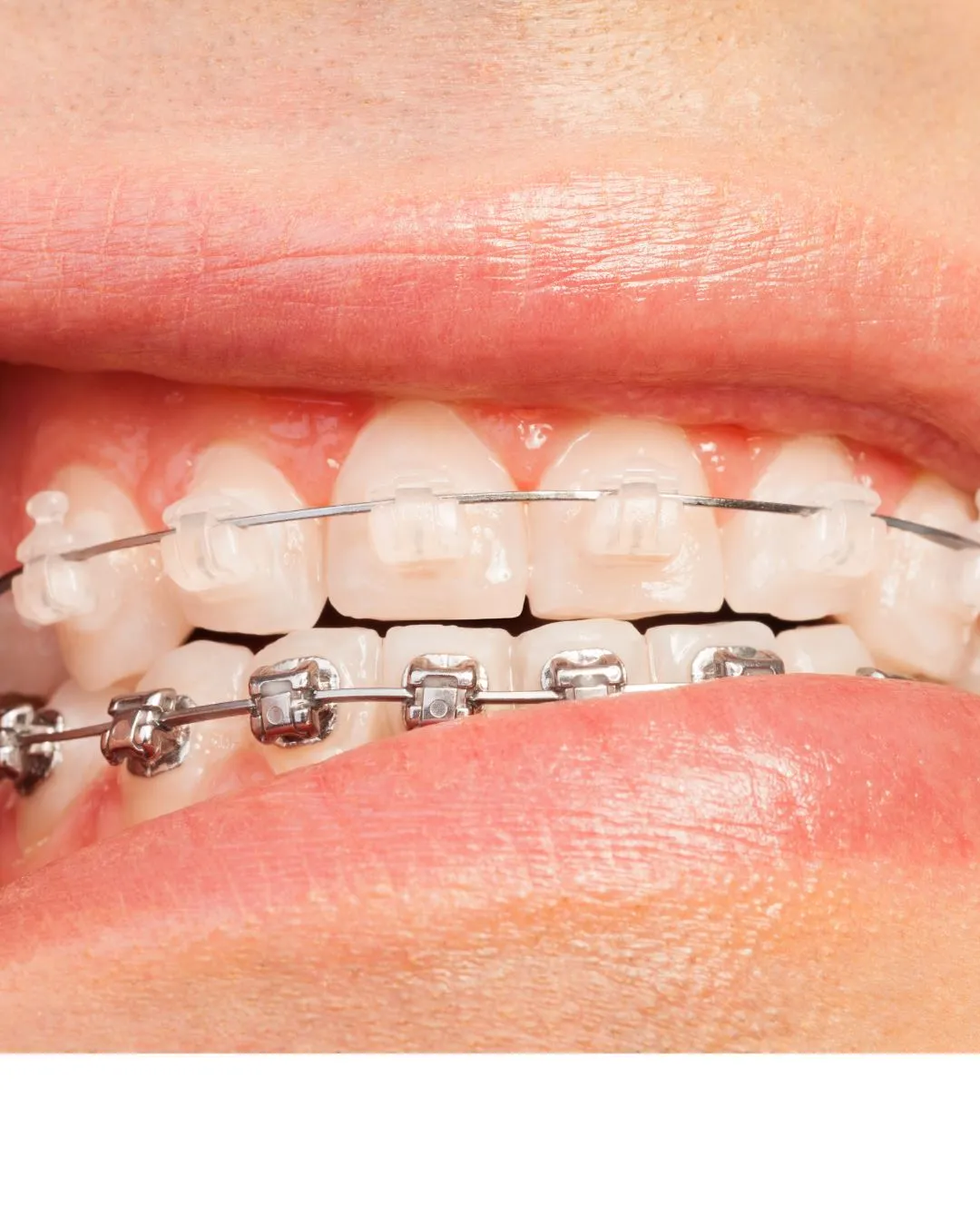 Brackets de Zafiro en CeDeMed